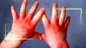 همه چیز درباره تب گوجه‌ فرنگی