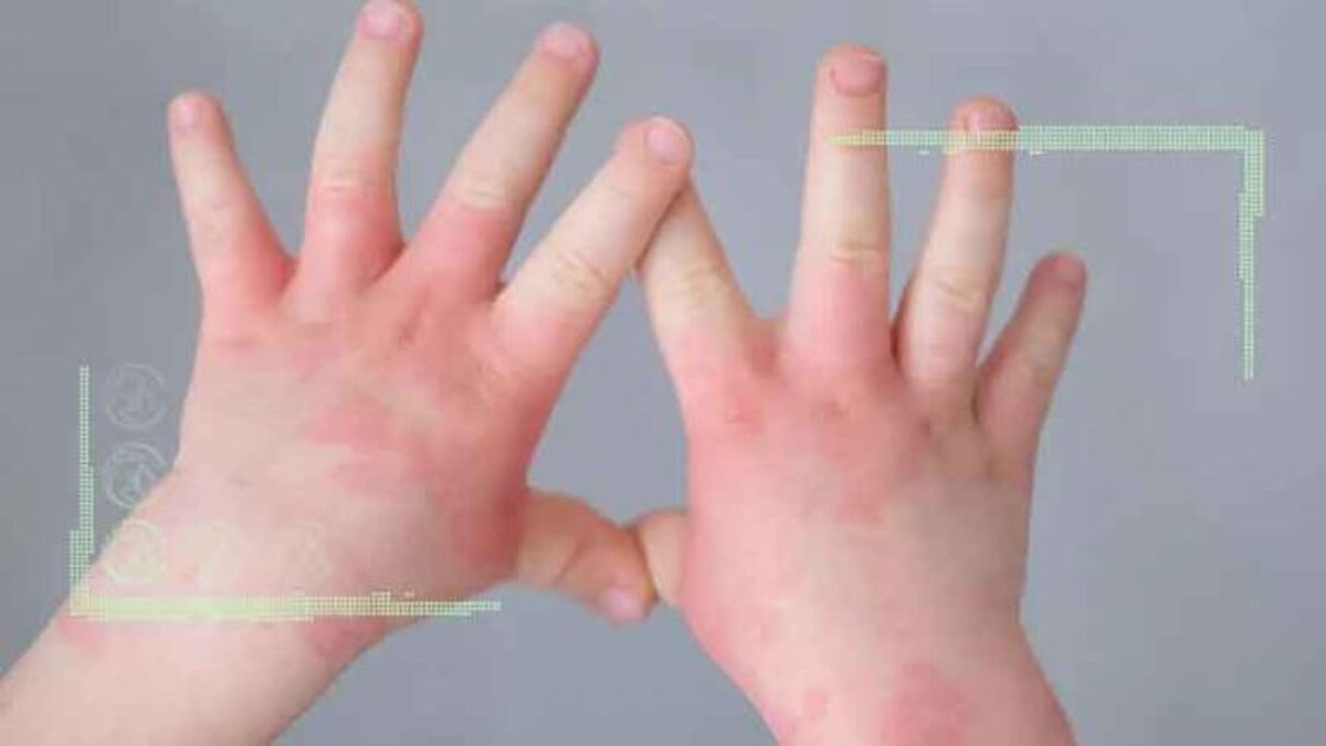همه چیز درباره تب گوجه‌ فرنگی