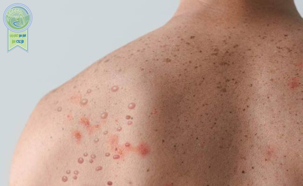 آبله میمونی و راه‌های انتقال/ سویه جدید آبله میمون کشنده است؟

